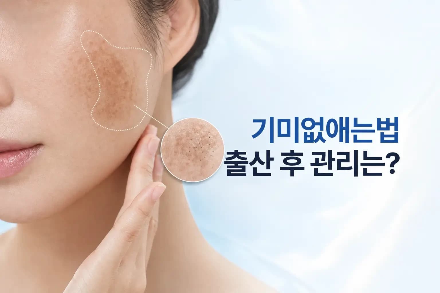 임신·출산 후 볼에 생긴 기미와 피코슈어 핸드피스, 색소 분해 확대 컷을 담은 기미없애는법 썸네일