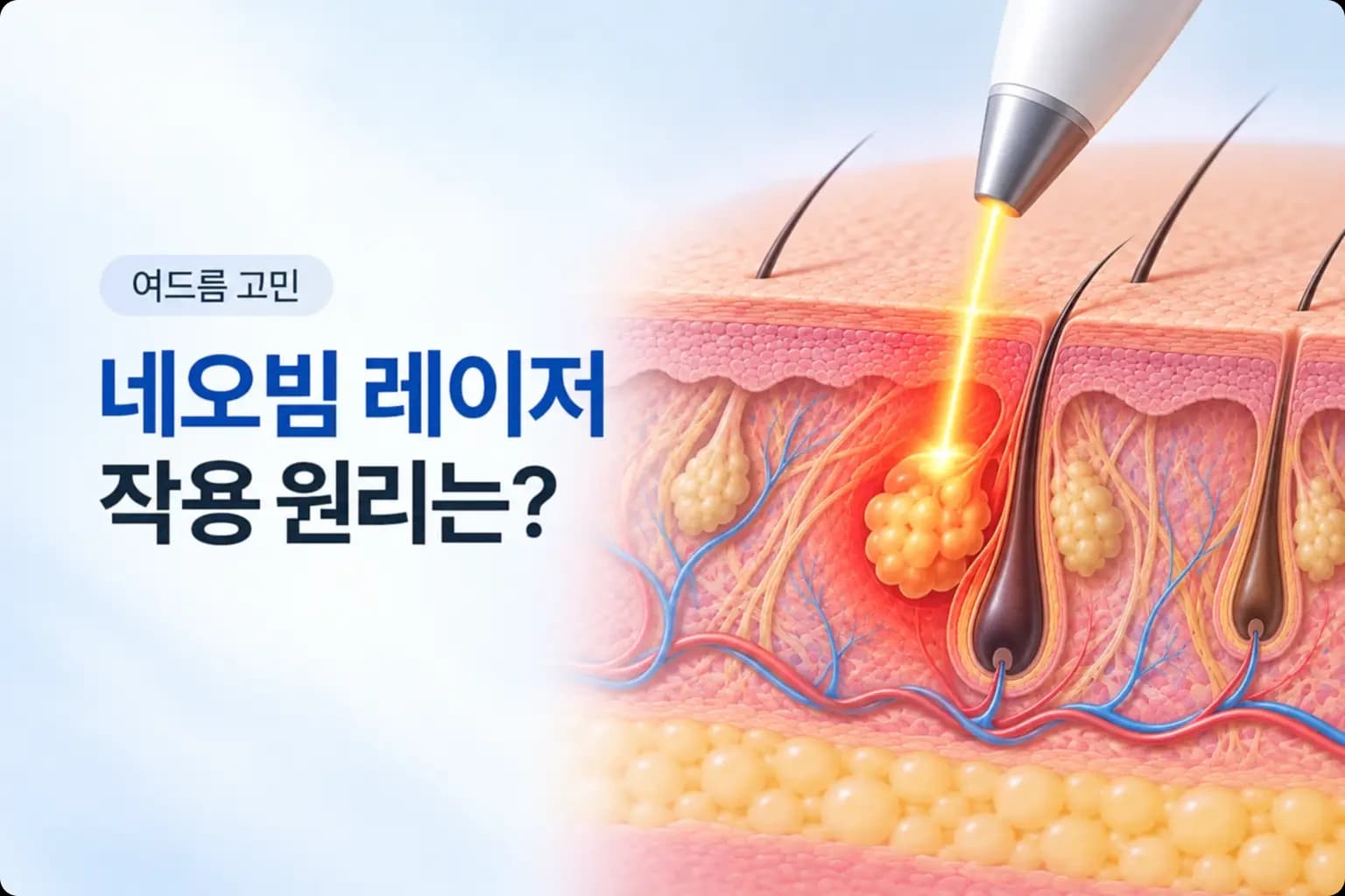 핸드피스 냉각 분사와 진피 속 피지선에 닿는 1450nm 레이저를 담은 네오빔레이저 원리 썸네일