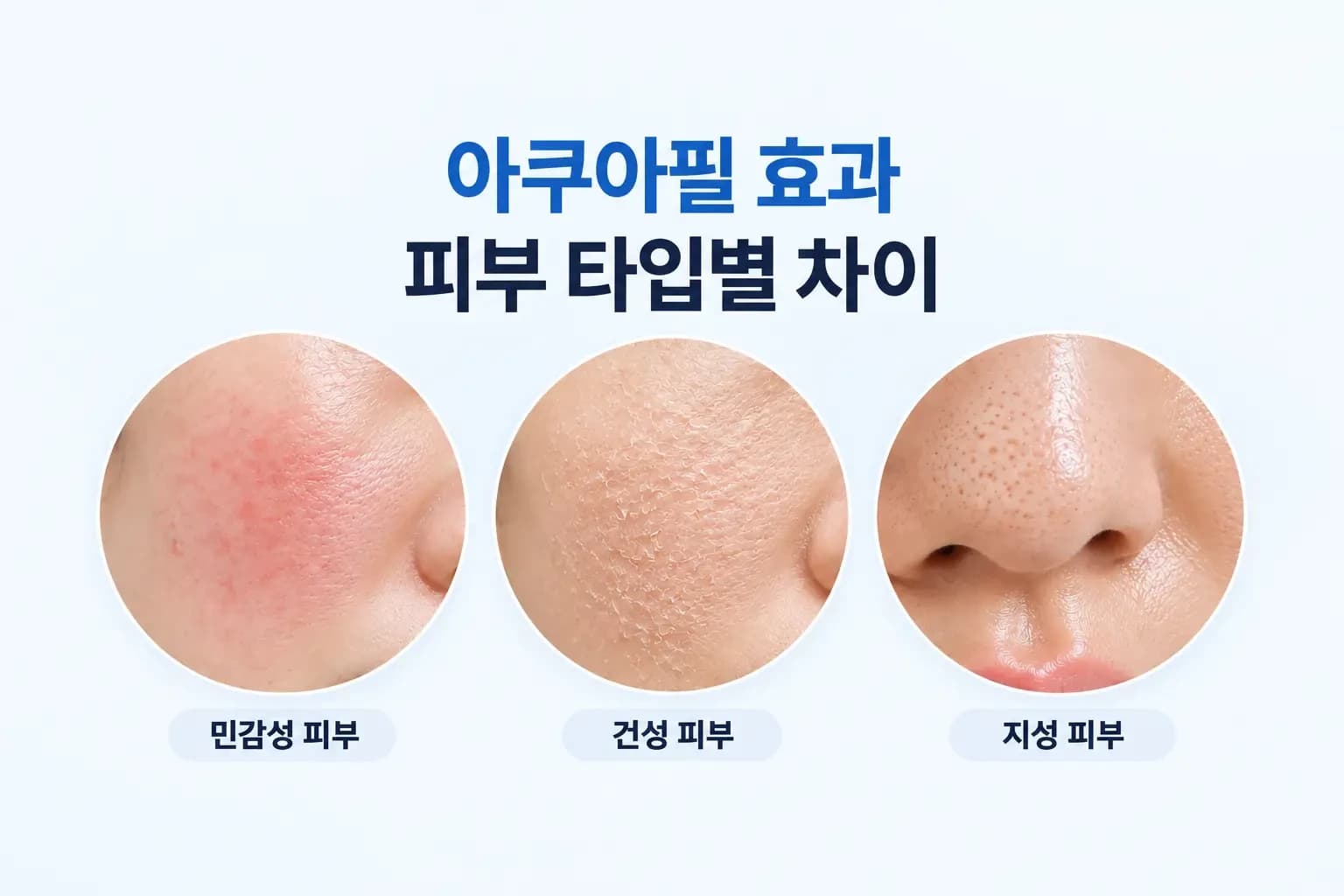 민감성·건성·지성 피부 확대 컷과 아쿠아필 핸드피스 팁의 흡입 장면을 담은 아쿠아필 효과 썸네일