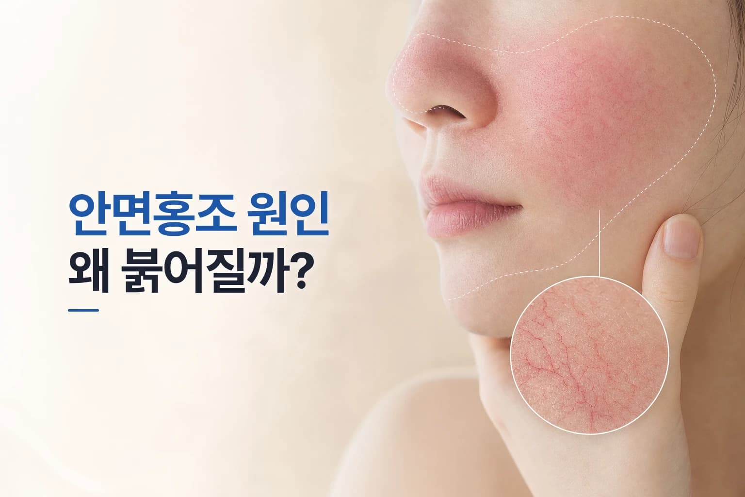 붉어진 볼과 코 주변 피부 아래 확장된 모세혈관을 확대 원형 컷으로 보여주는 안면홍조 원인 썸네일